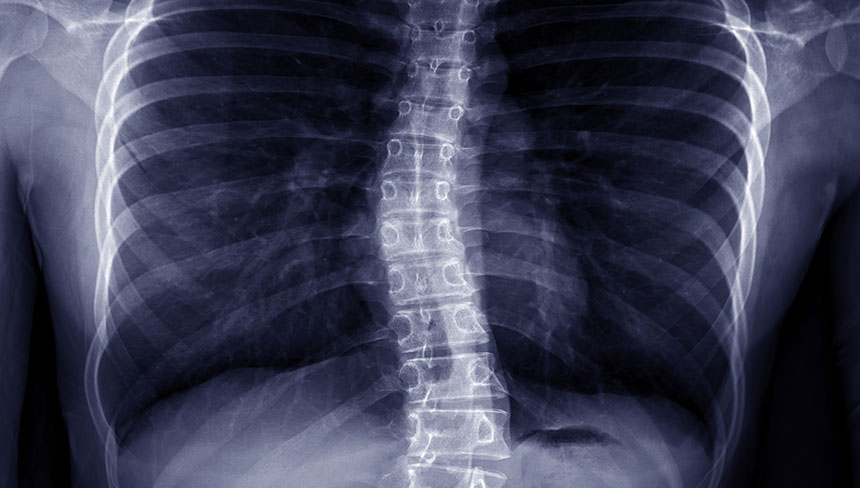 patient needing scoliosis  treatment in Salinas