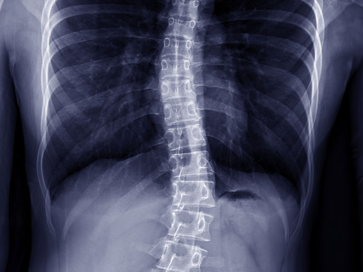 scoliosis treatment in Salinas